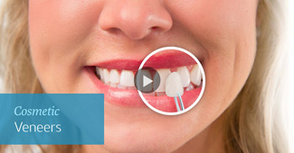 Cosmetic Veneer video by Semiahmoo Dental in South Surrey