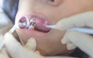 white or silver fillings