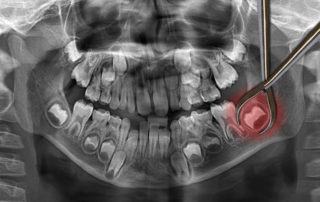 wisdom tooth after 30