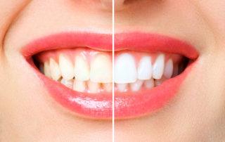 woman teeth before and after teeth whitening