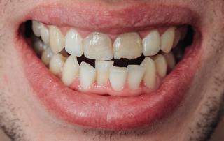 there are lots of prevention that you can avoid chipped teeths