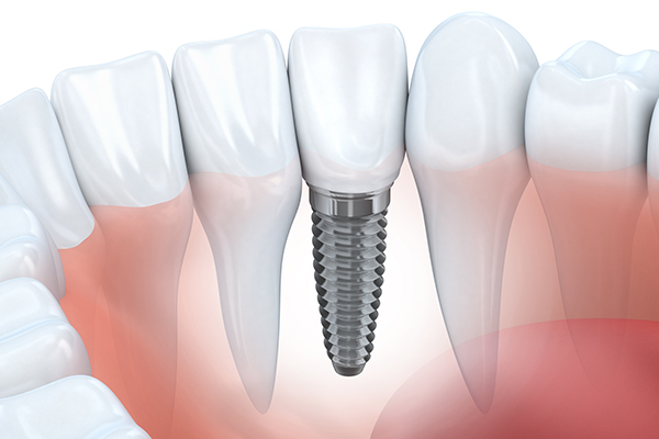 If you need dental implant surgery in South Surrey, please contact our dental clinic.