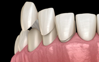 if you need to whiten your veneers in south surrey please contact our dentist