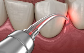 Learn more about laser periodontal treatment for your gum disease
