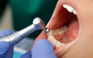 Image of teeth cleaning by professional hygienist.