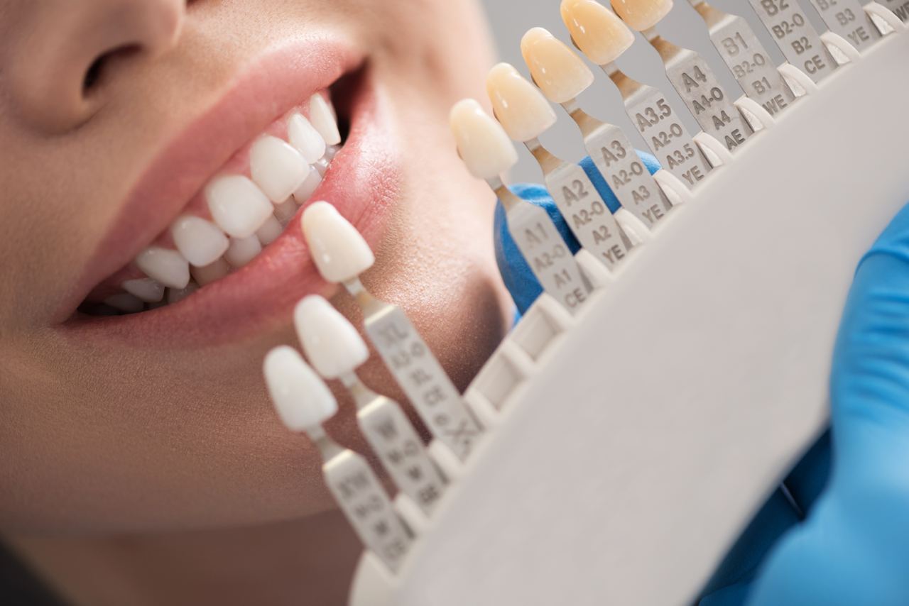 dental crown material